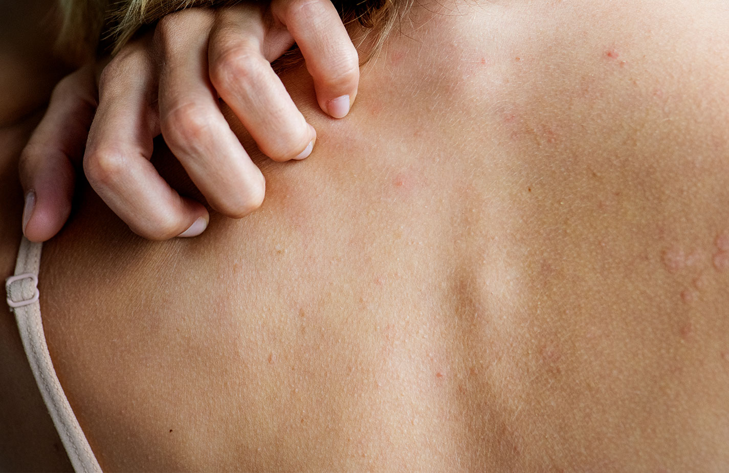 Doenças de pele: diga não ao preconceito